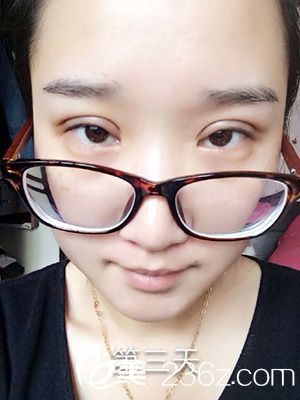 做部分切開法雙眼皮之后