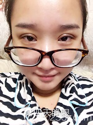 做部分切開法雙眼皮之后