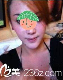 自體脂肪營造臥蠶之前