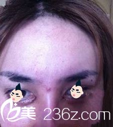 自體脂肪營造臥蠶之后