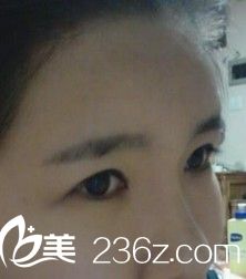 自體脂肪移植豐額頭