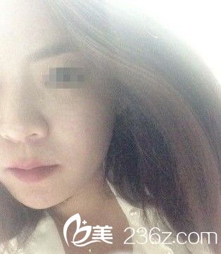 臉部自體脂肪移植