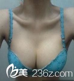 假體隆胸之后