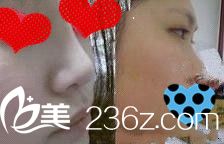 膨體隆鼻