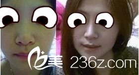 膨體隆鼻
