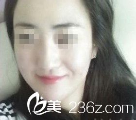 注射瘦臉除皺瘦臉