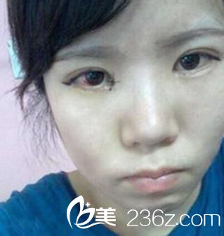 開內(nèi)眼角