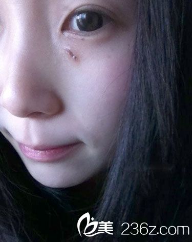 激光去痣