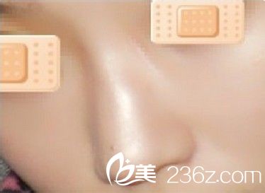 自體軟骨隆鼻
