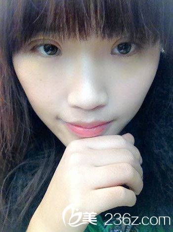 部分切開法雙眼皮