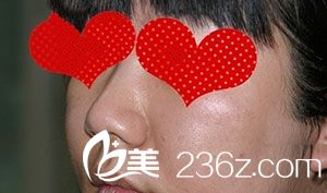膨體隆鼻