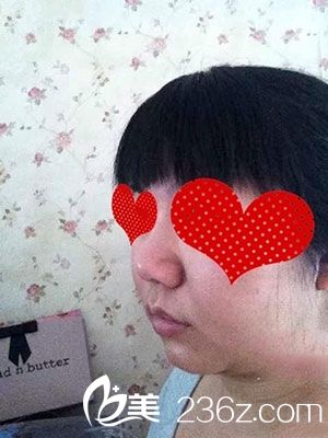 膨體隆鼻