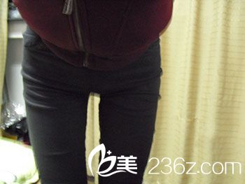 大腿吸脂