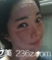 臉部自體脂肪移植