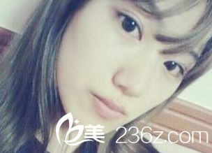 自體脂肪豐額頭