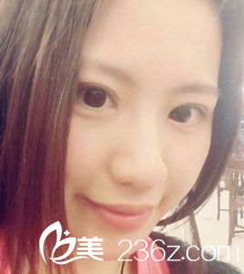 切開(kāi)法雙眼皮