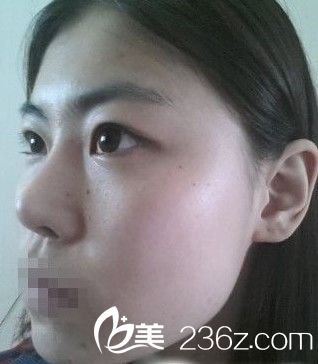 自體脂肪墊下巴