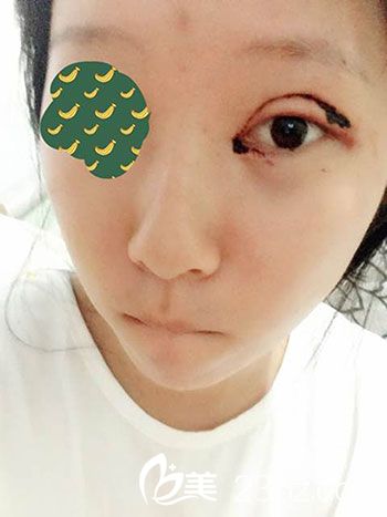 術(shù)后恢復(fù)