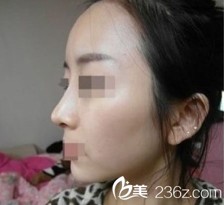 自體脂肪豐額頭