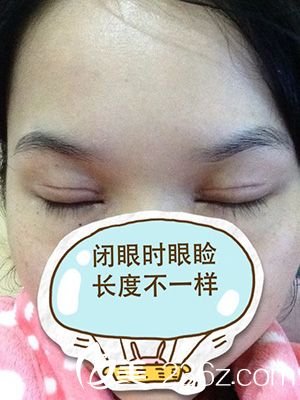 開內(nèi)眼角