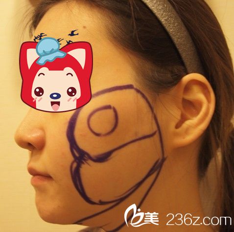 V-line瓜子臉整形