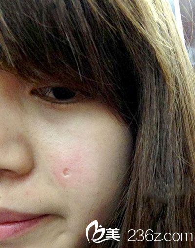 激光點痣