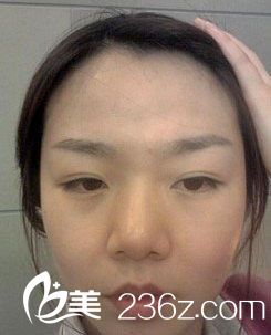 臉部自體脂肪移植