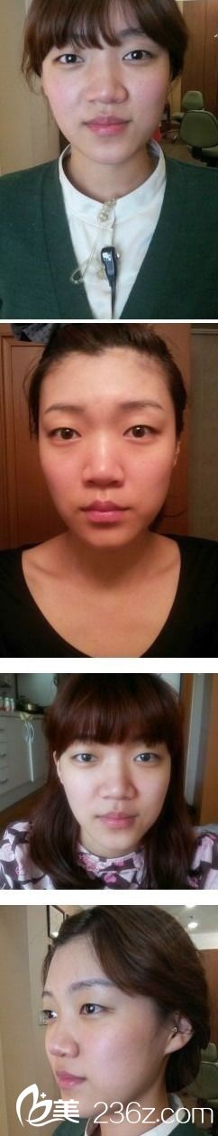 自體脂肪移植豐額頭