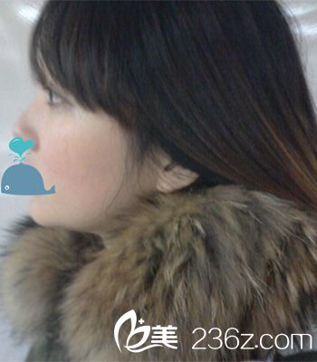 V-line瓜子臉手術(shù)