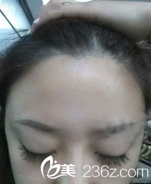 自體脂肪移植豐額頭