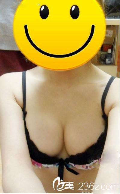 假體隆胸