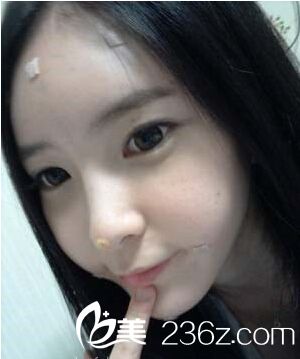 假體植入豐額頭