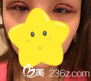 切開(kāi)法雙眼皮