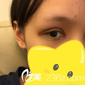 切開(kāi)法雙眼皮