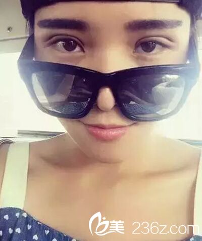 部分切開法雙眼皮