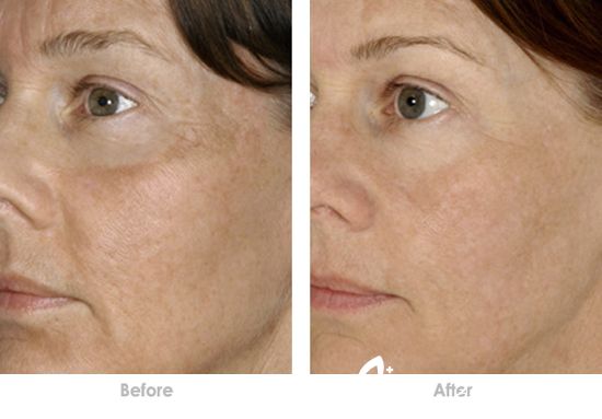 玻尿酸除皺多少錢 玻尿酸注射除皺價格