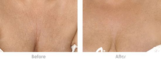 玻尿酸除皺多少錢 玻尿酸注射除皺價格