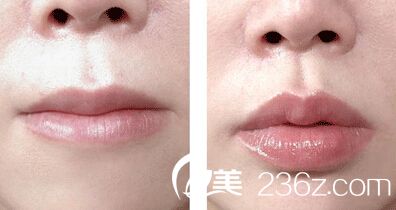 注射玻尿酸豐唇多少錢(qián)一針