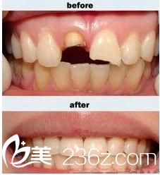 烤瓷牙修復(fù)前后對(duì)比圖