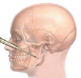 磨下頜角 風(fēng)險到底有多大？