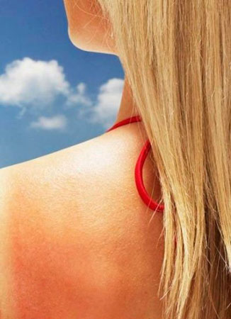 全面解決較常見的夏日肌膚問題