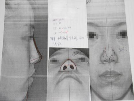 鼻整形不要當(dāng)場(chǎng)決定 網(wǎng)專訪沈國(guó)雄院長(zhǎng)