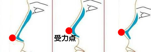 單純假體隆鼻的受力點(diǎn)在鼻尖 單純假體隆鼻的受力點(diǎn)在鼻尖