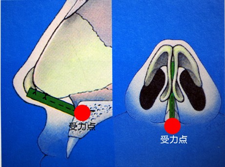 鼻綜合整形的受力點(diǎn)在上頜骨 鼻綜合整形的受力點(diǎn)在上頜骨