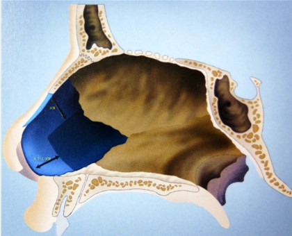 從側(cè)面看鼻中隔 從側(cè)面看鼻中隔