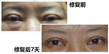 姜洪濤主任：雙眼皮修復(fù)需因“眼”而異