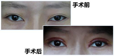 姜洪濤主任：雙眼皮修復(fù)需因“眼”而異