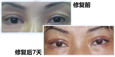 姜洪濤主任：雙眼皮修復(fù)需因“眼”而異