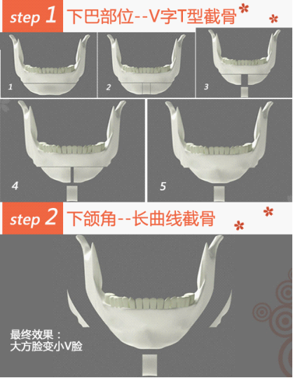 李志海院長:國內(nèi)下頜角手術(shù)也能做出“韓范兒”臉
