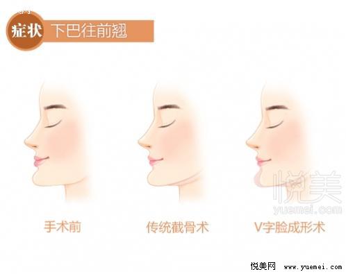 李志海院長:國內(nèi)下頜角手術(shù)也能做出“韓范兒”臉